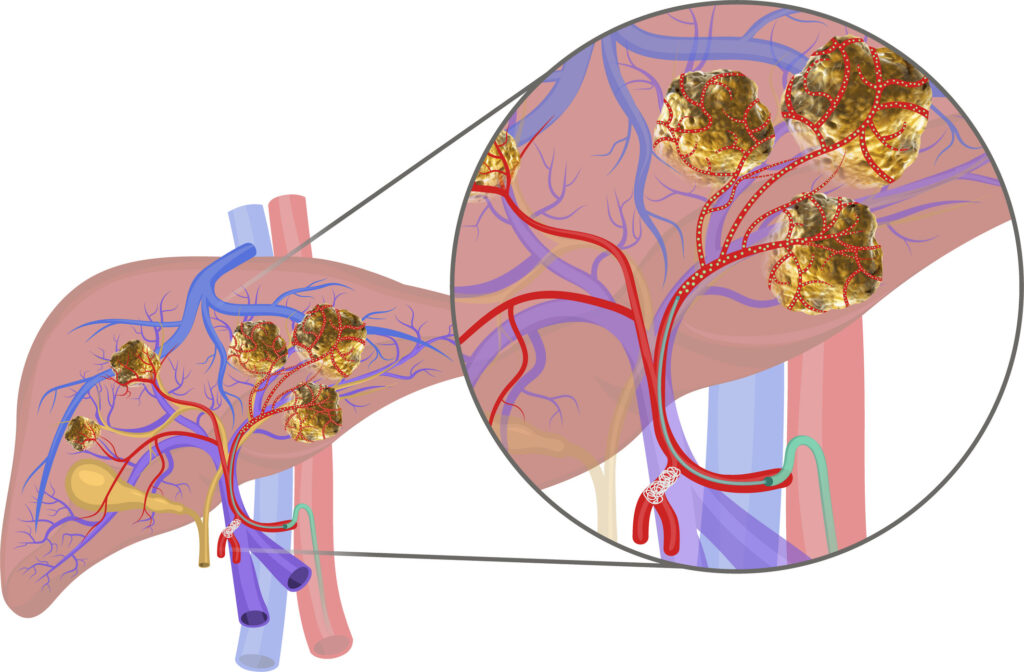 Internal Radiation Therapy Market