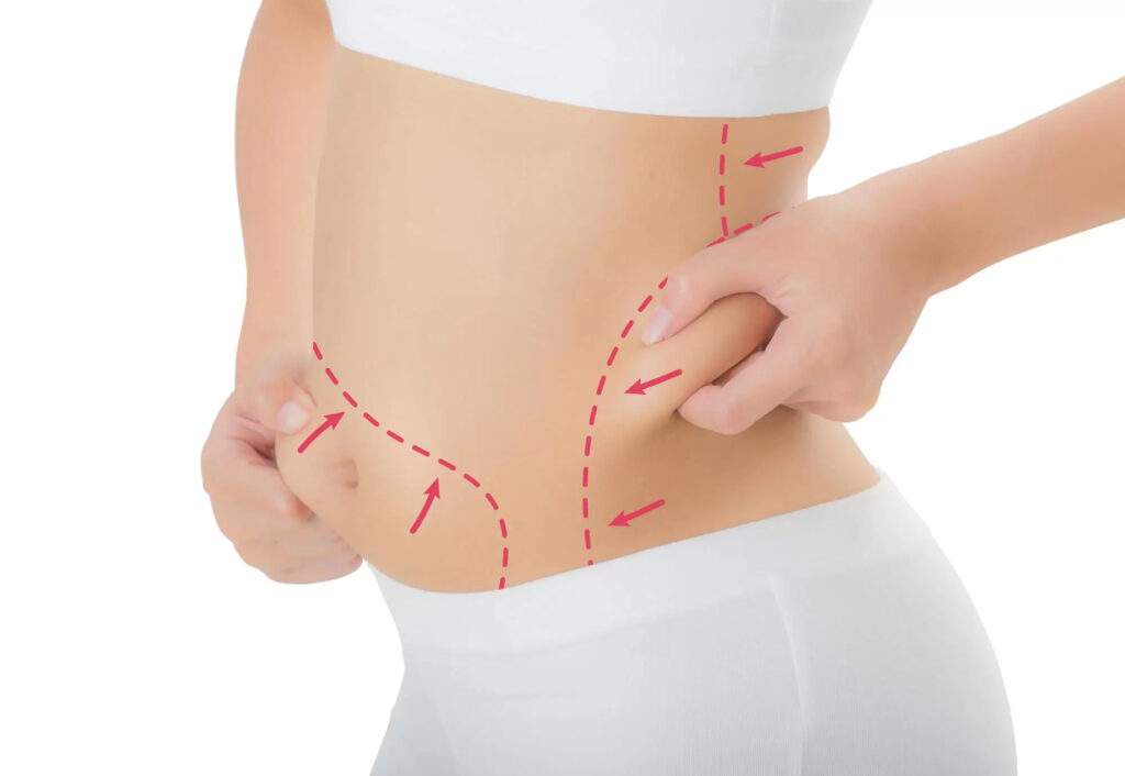 Liposuction Market