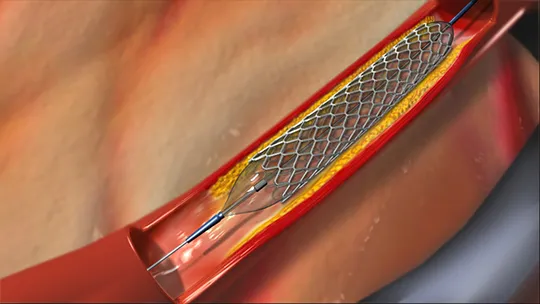 Neurovascular Stent Retrievers Market