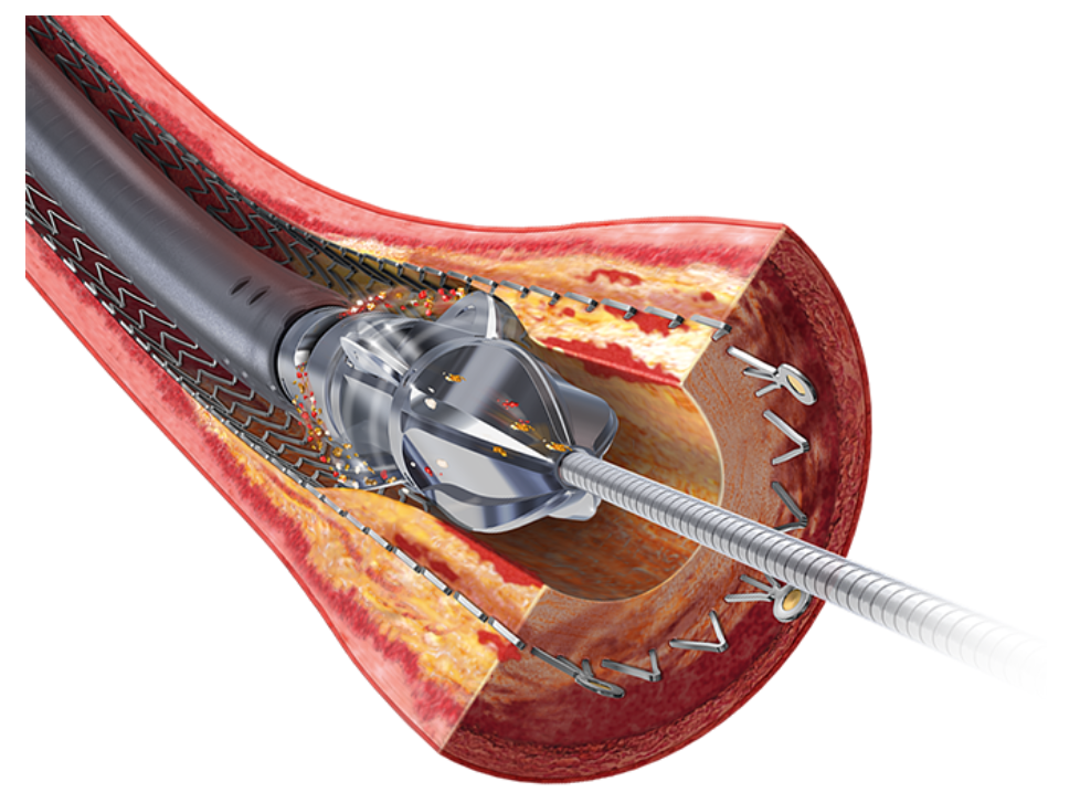 Non-Vascular Stents Market