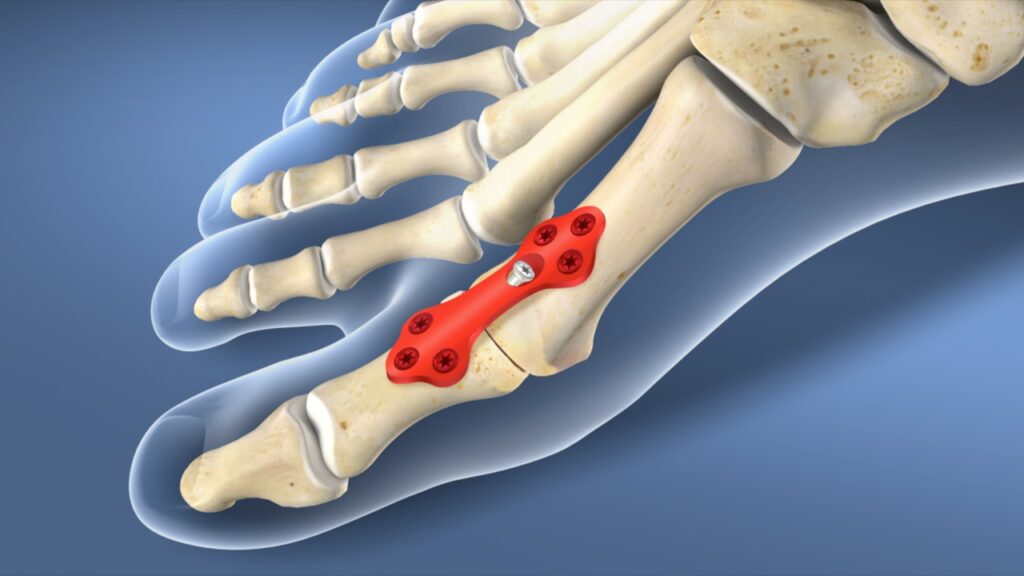 Osteotomy Plates Market