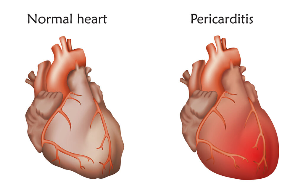 Pericarditis Treatment Market