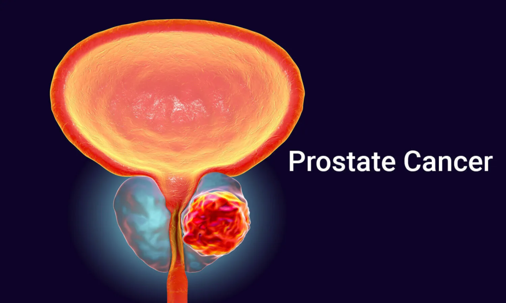 Prostatic Cancer Market