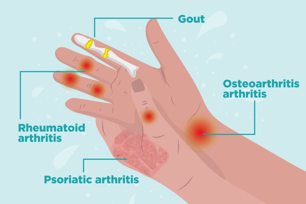 Psoriatic Arthritis Treatment Market