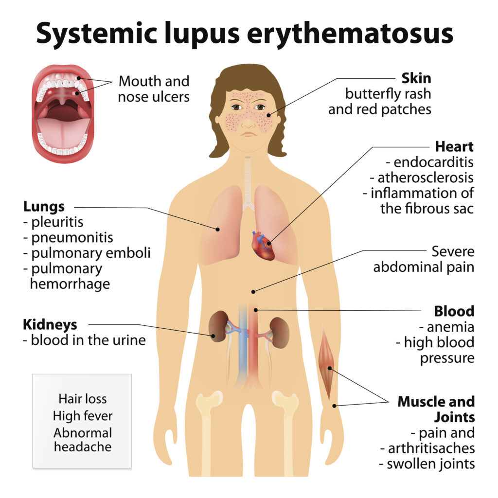 Systemic Lupus Erythematosus (SLE) Drugs Market