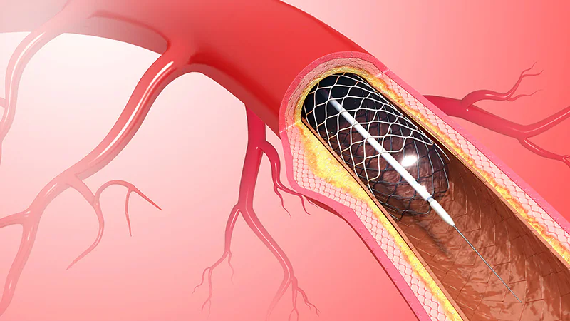 Thoracic Vascular Stent Grafts Market