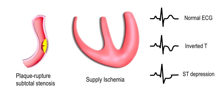 Unstable Angina Therapeutics Market