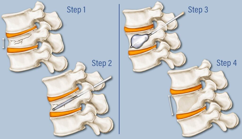 Vertebroplasty and Kyphoplasty Devices Market