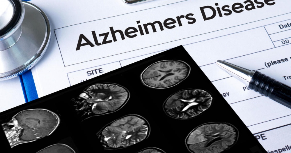 Alzheimer’s Diagnostics and Therapeutics Market