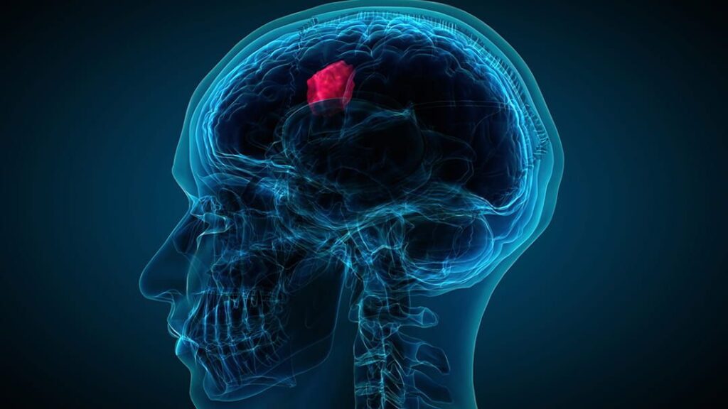 Brain Tumor Treatment Market