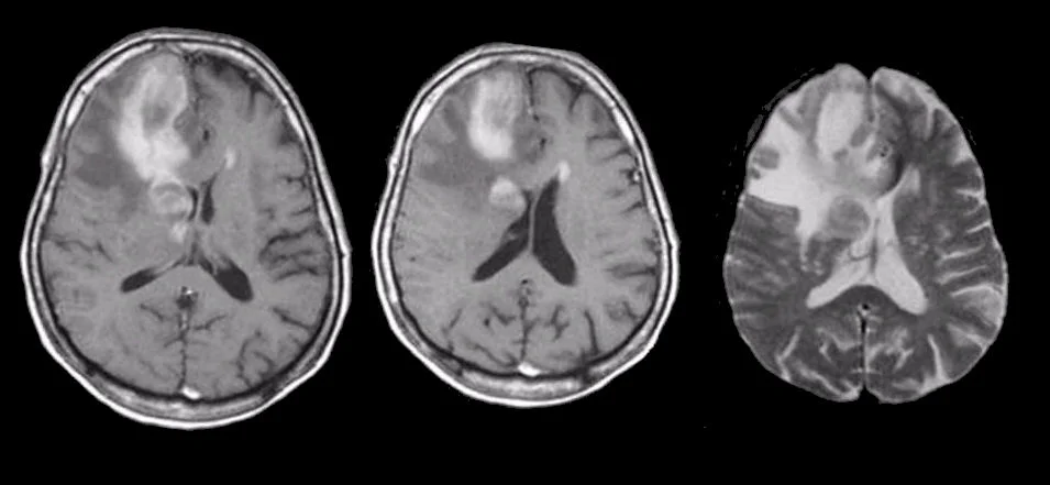 Central Nervous System Lymphoma Treatment Market