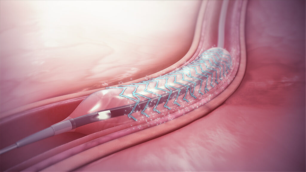 Coronary Stent Market in India