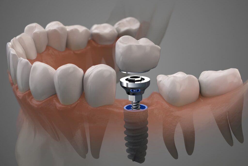 Dental Implant and Prosthetic Market