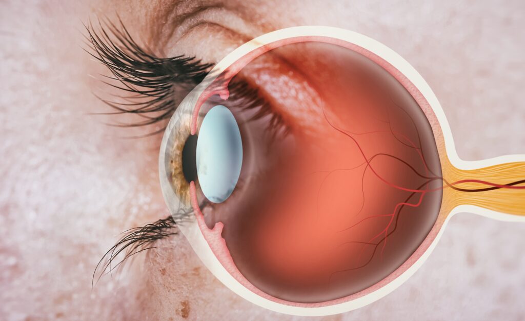 Diabetic Macular Edema Market