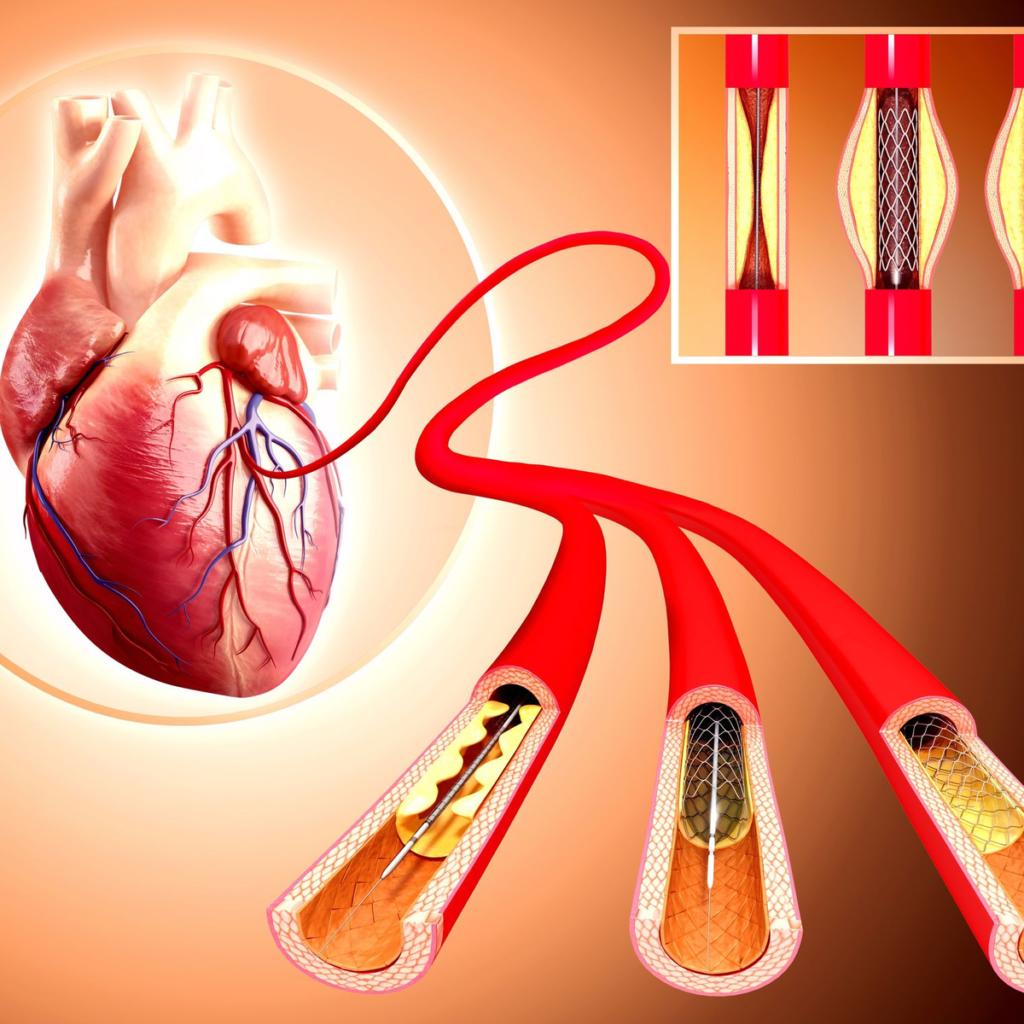 Coronary Stents Market