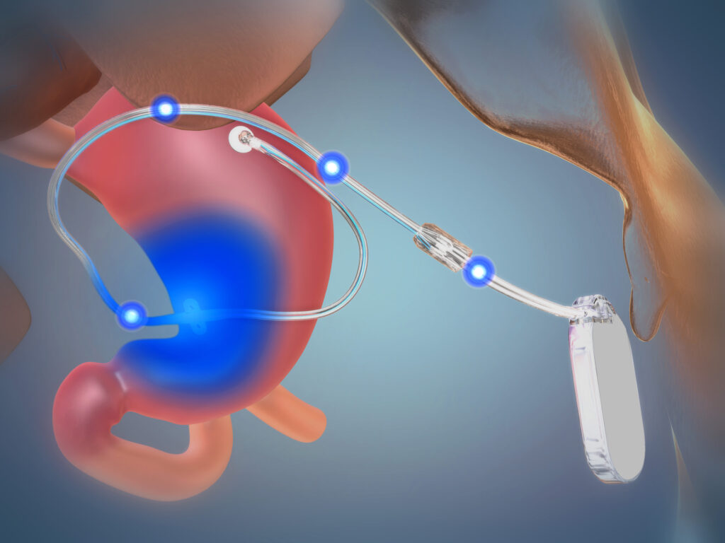 Gastric Electrical Stimulators Market