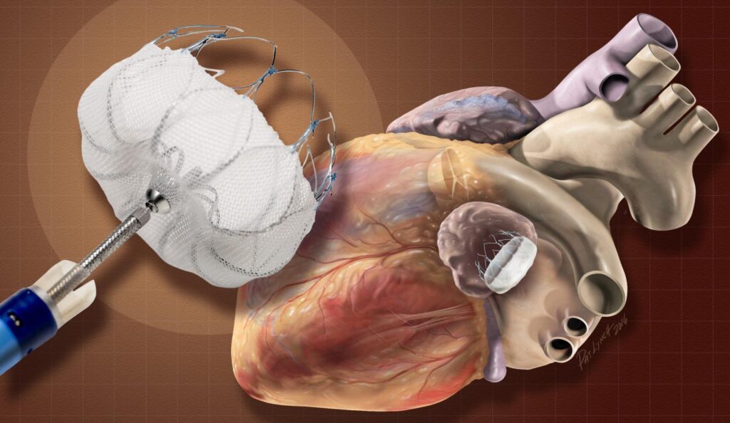 Neurovascular Device Market