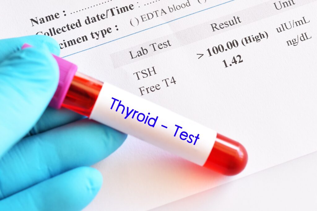 Thyroid Function Test Market