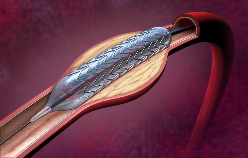 Industrial Analysis of Coronary Stent in India