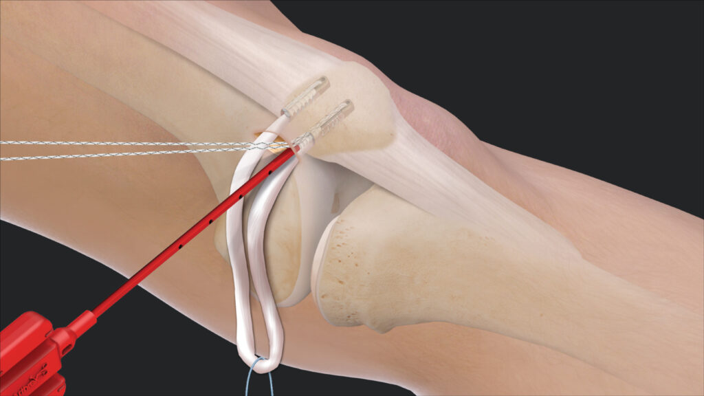 Ligament Augmentation Market