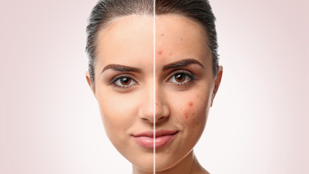 Moderate-to-Severe Acne Treatment Market