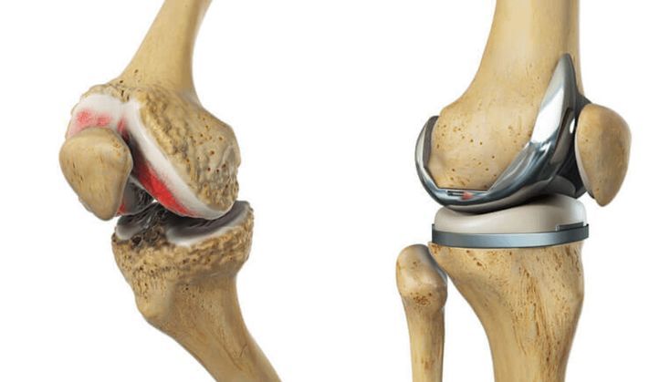 Orthopaedic Bone Cement and Casting Material Market