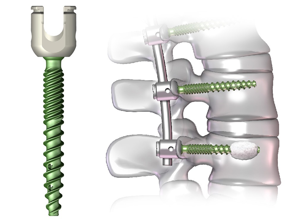 Pedicle Screw System Market