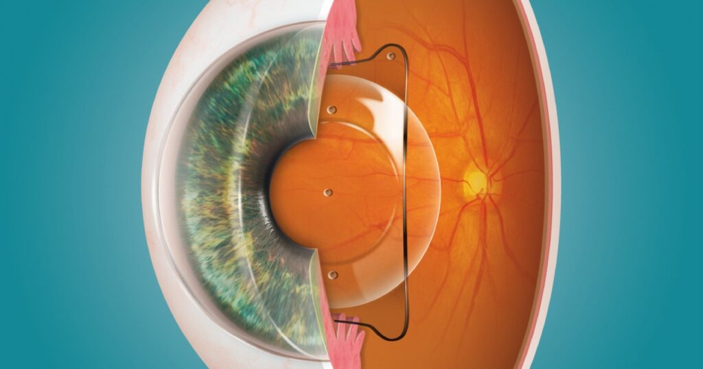 Intraocular Lens Market 