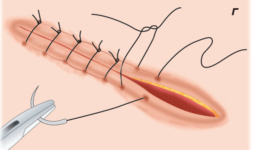 Surgical Sutures Market