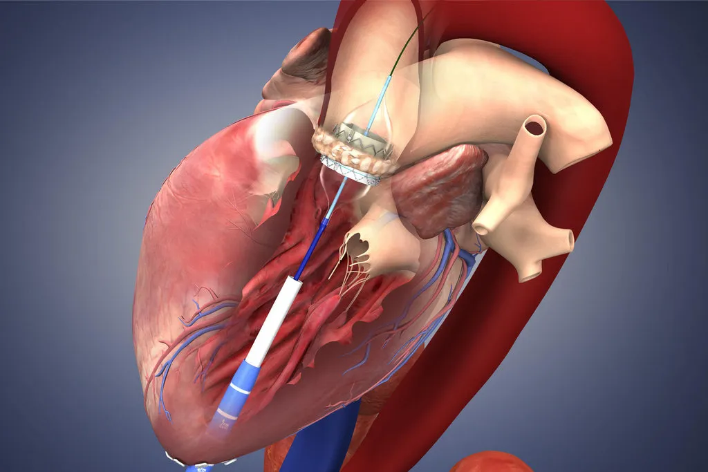 Transcatheter Mitral Valve Market