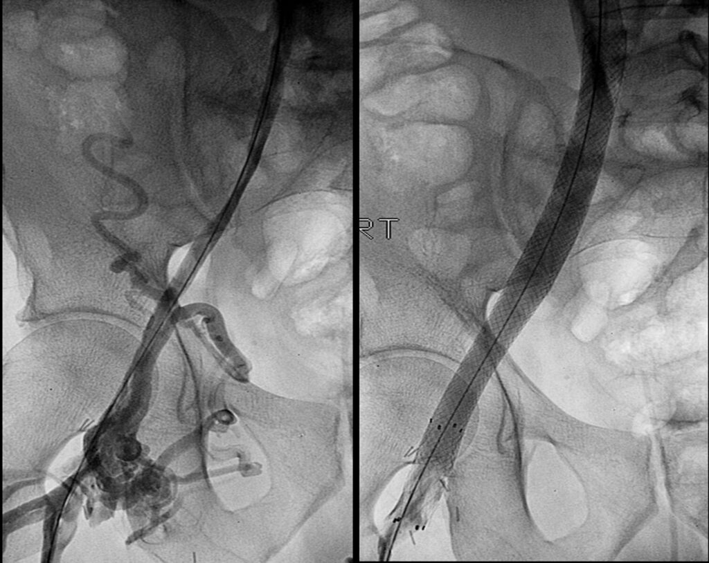 Venous Stents Market