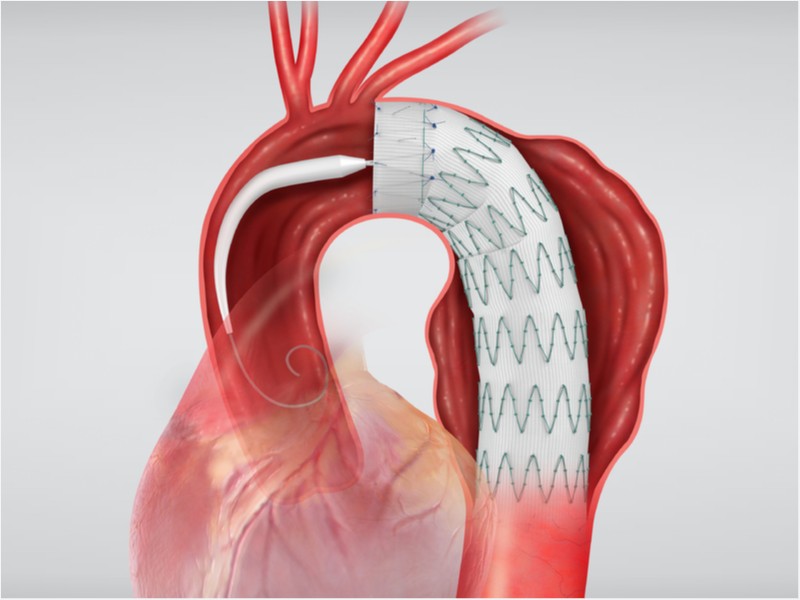 Aortic Stents Grafts Market