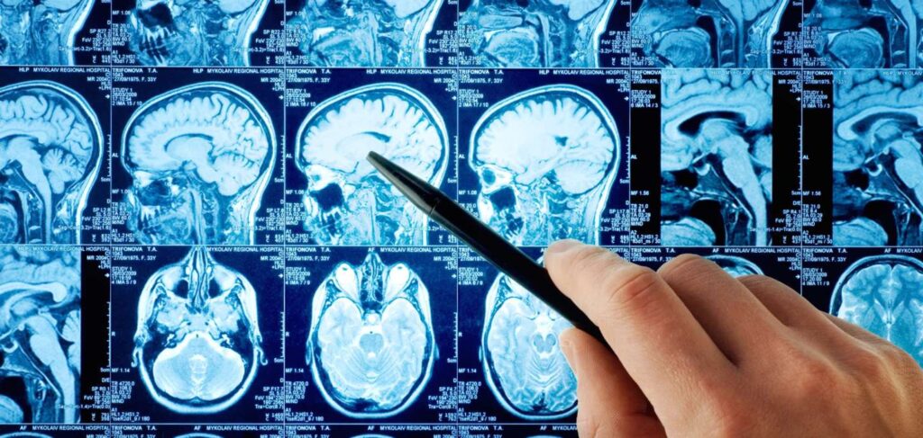 Brain Tumor Treatment Market