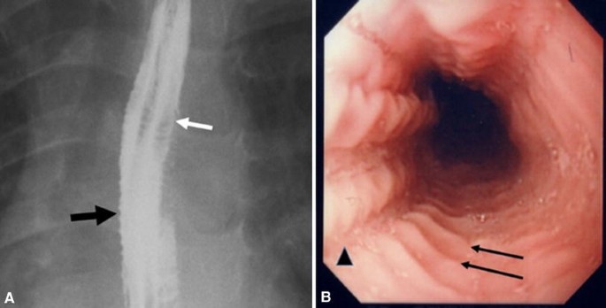 Esophageal Implant Market