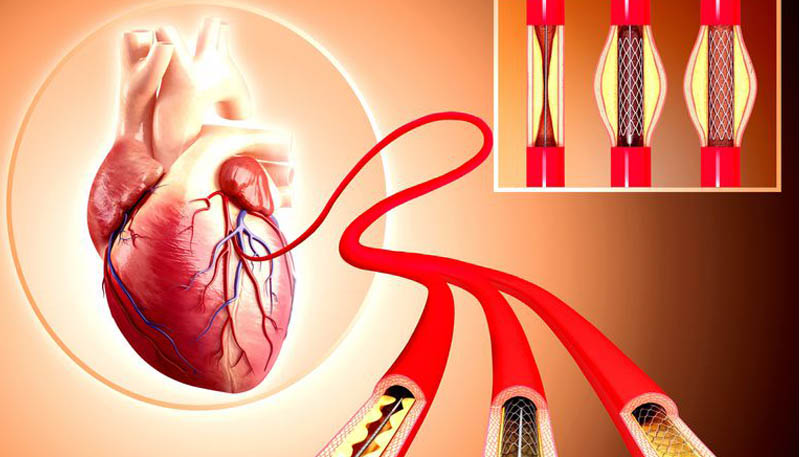 Industrial Analysis of Coronary Stent in India