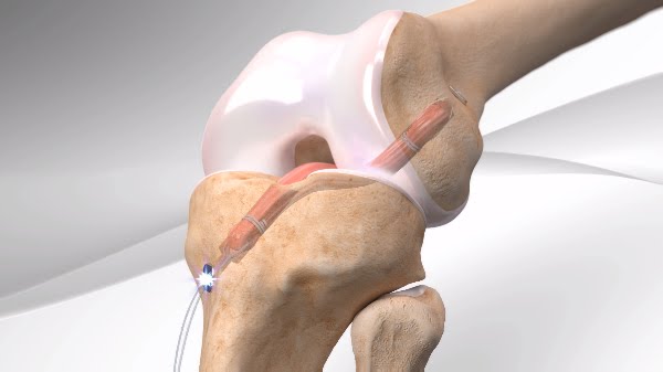 Ligament Augmentation Market