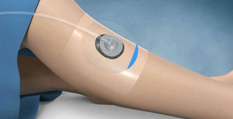 Negative Pressure Wound Therapy Market