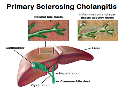 Primary Sclerosing Cholangitis (PSC) Market