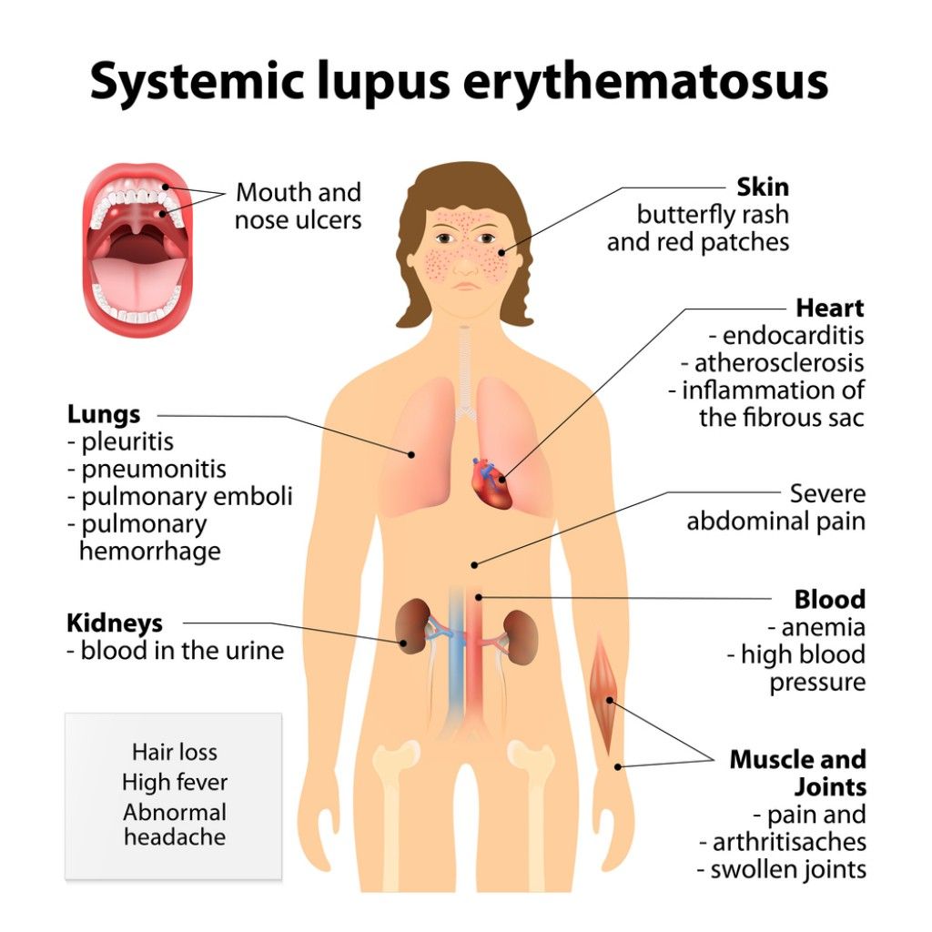 Systemic Lupus Erythematosus (SLE) Drugs Market