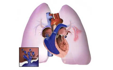 Chronic Pulmonary Hypertension Treatment Market