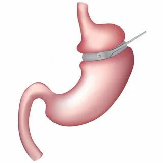 Gastric Bands Market