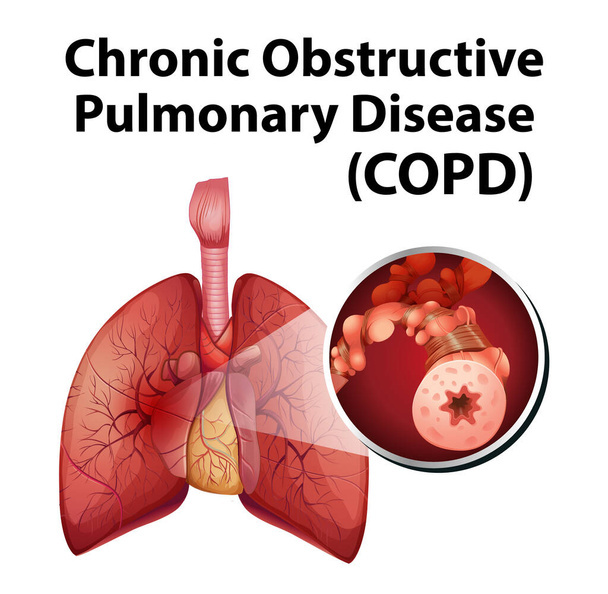 Global Chronic Obstructive Pulmonary Disease (COPD) Market