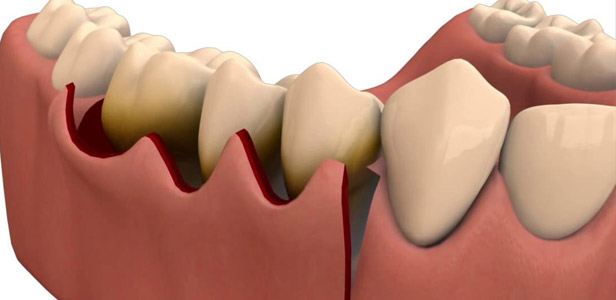 Global Dental Flap Surgery Market