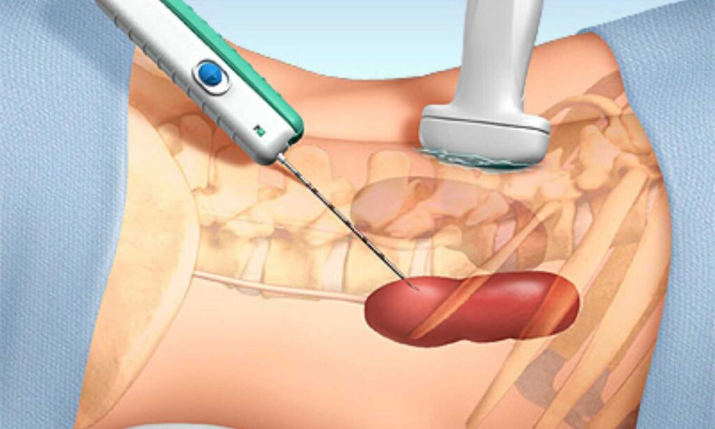 Lung Biopsy Systems Market