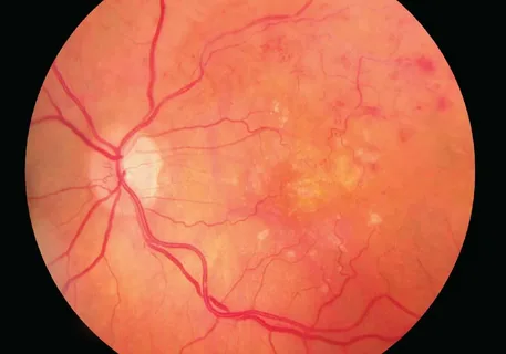 Retinal Vasculitis Treatment Market