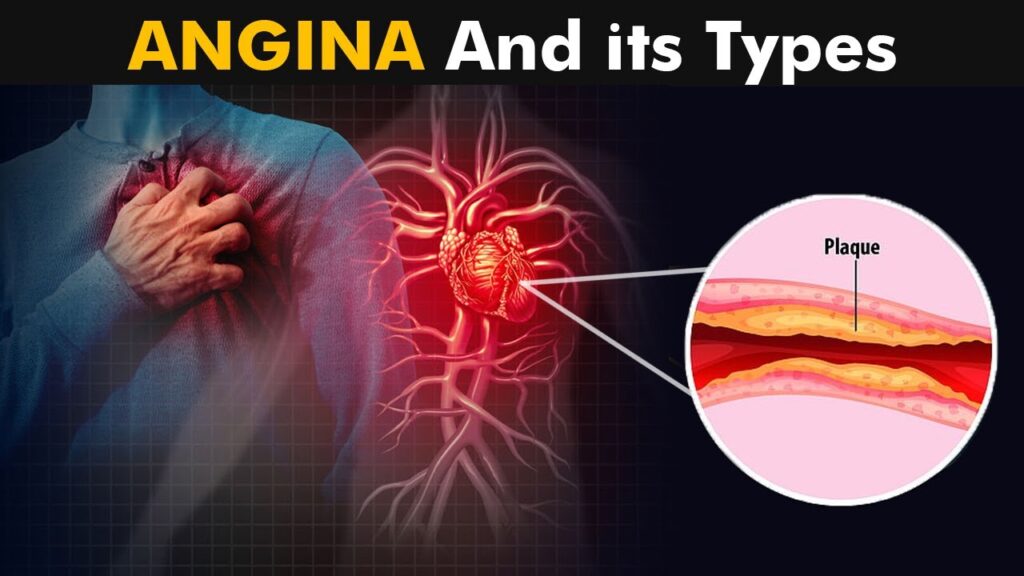 Stable Angina Management Market