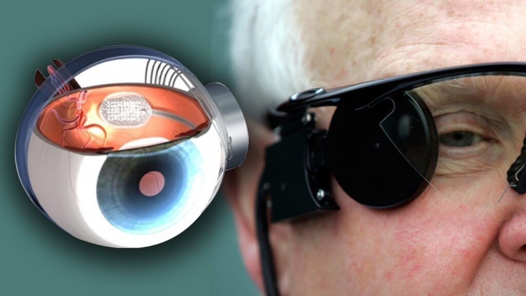 Bionic Eye Market