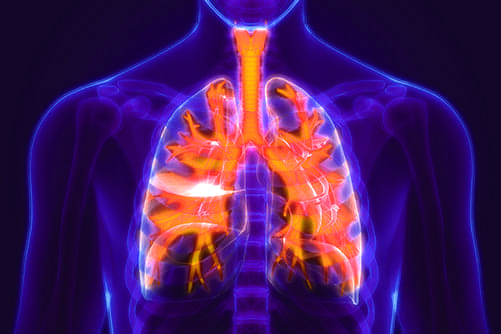 Bronchiectasis Therapeutic Market