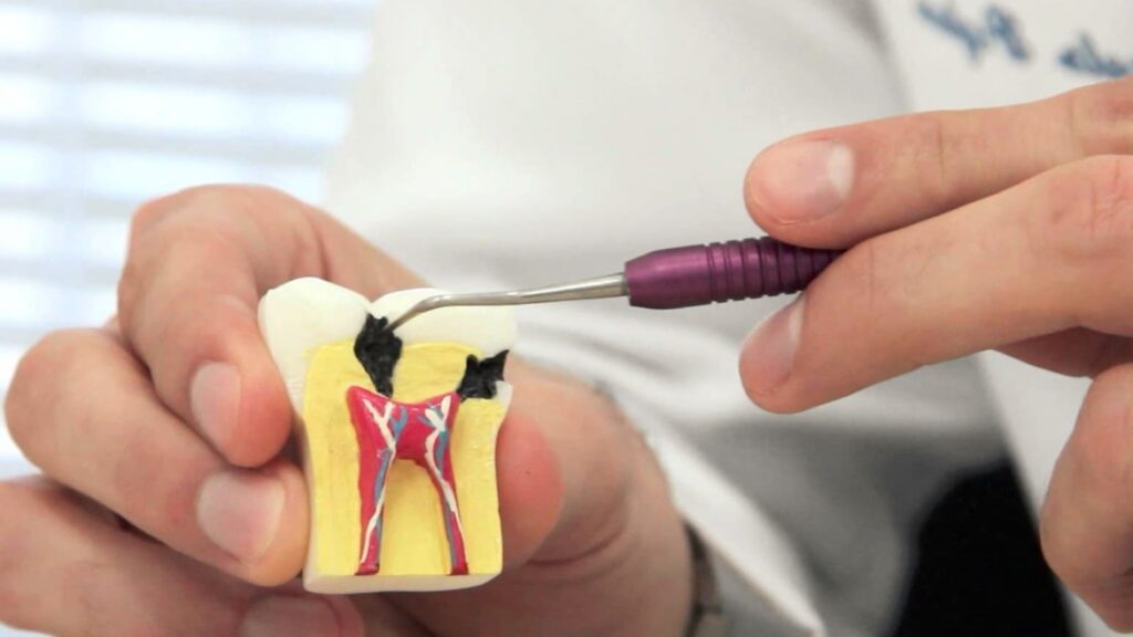 Dental Caries and Endodontic Market