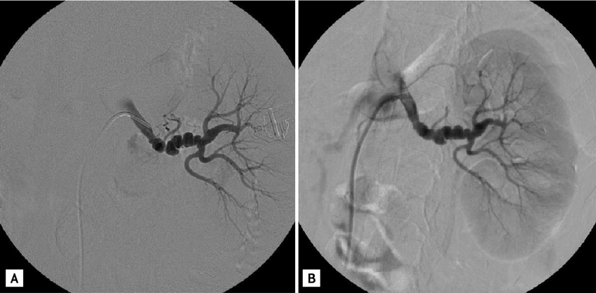 Digital Subtraction Angiography Market